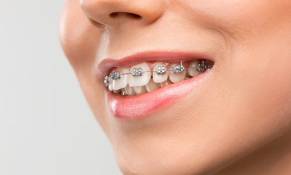 Aligners in pune, Laxmi road, Camp