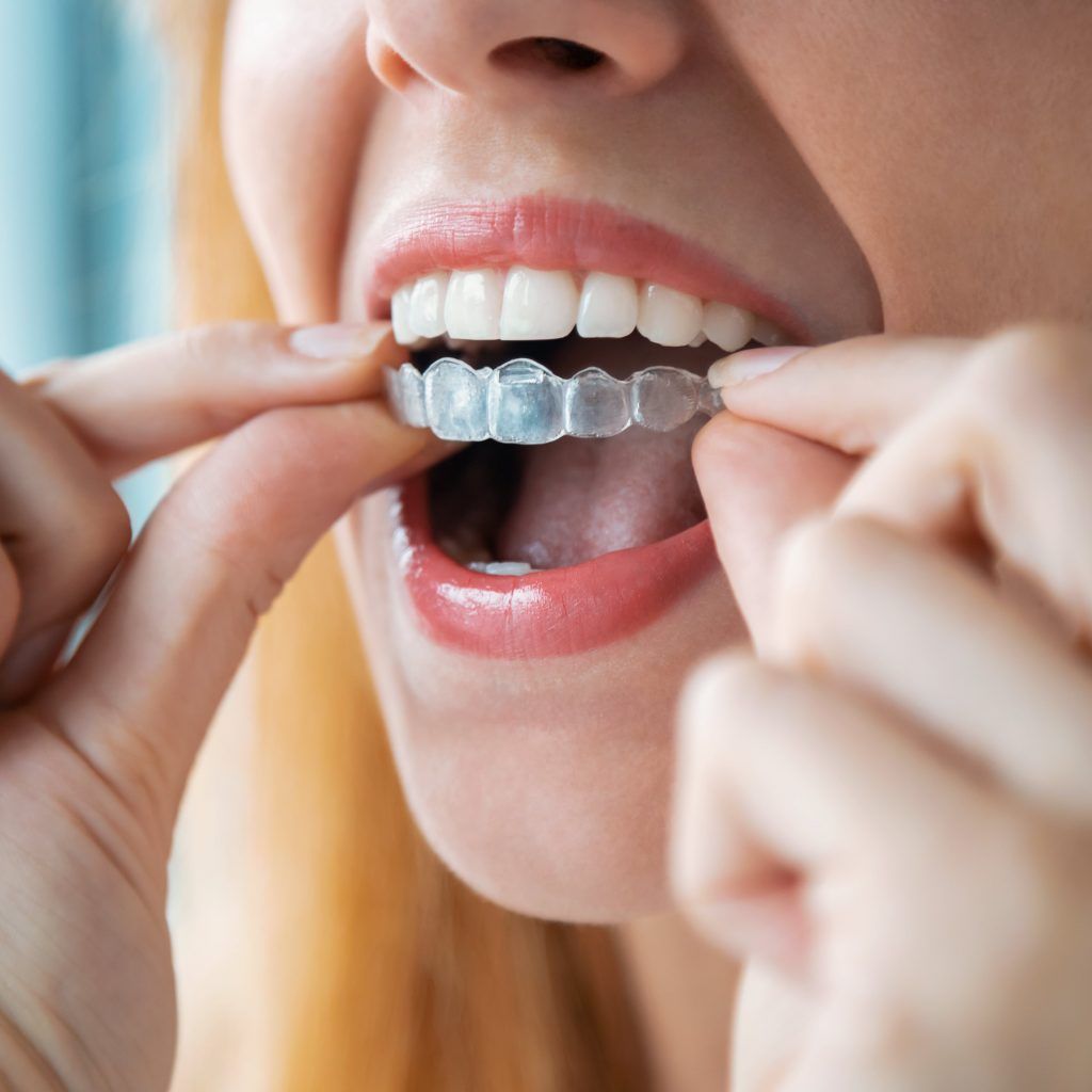 Teeth Whitening