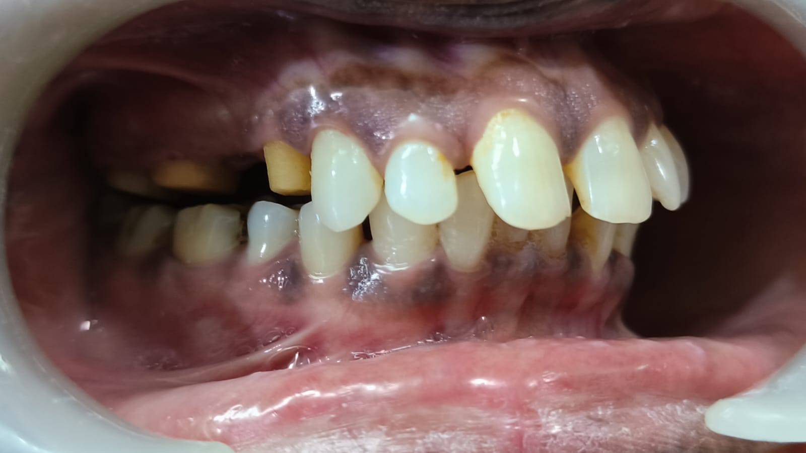 Pediatric dentistry in pune