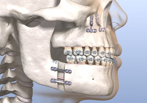 Corrective Jaw Surgeries