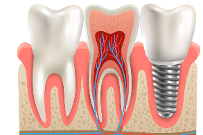 Dental Implant in pune, Laxmi road, Camp